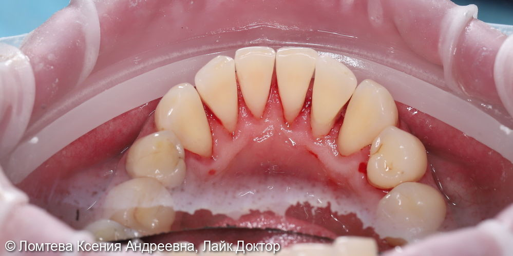 Профессиональная гигиена зубов - фото №6