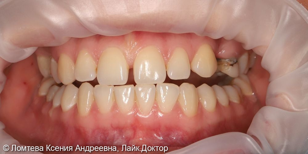 Профессиональная гигиена зубов - фото №1
