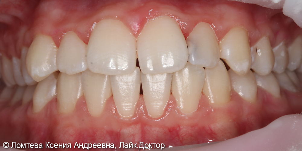 Профессиональная гигиена зубов - фото №3