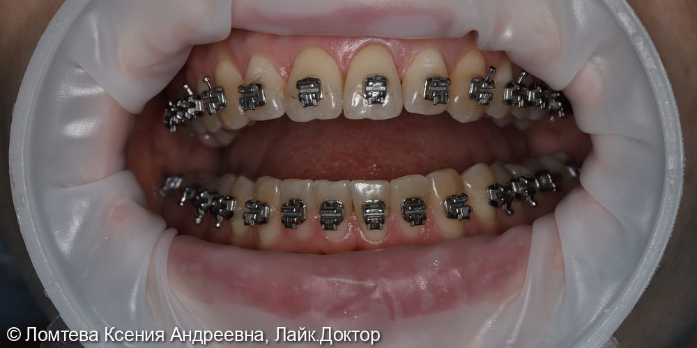 Профессиональная гигиена зубов - фото №1