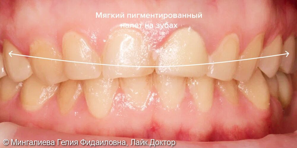 Профессиональная гигиена полости рта - до