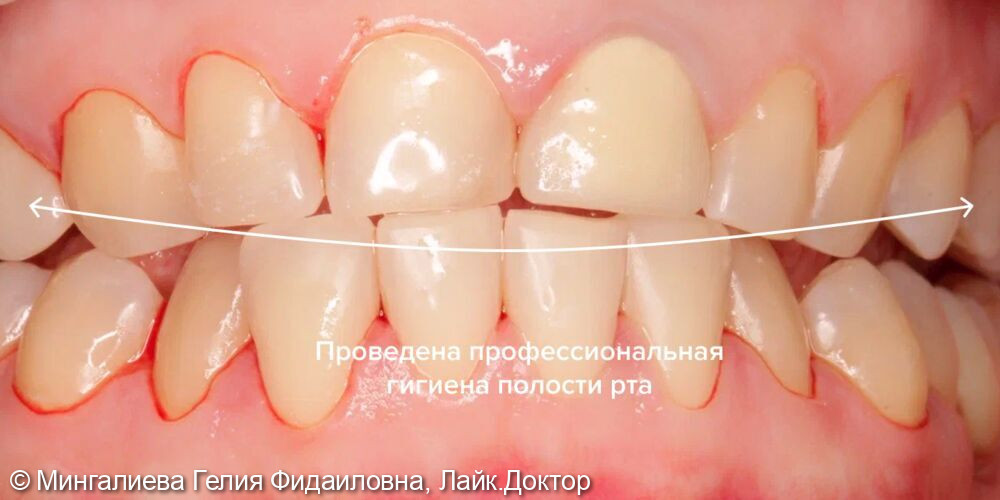 Профессиональная гигиена полости рта - после