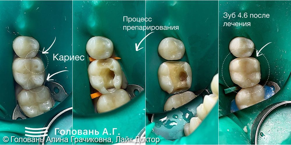 Лечение кариеса зуба 4.6 - фото №1