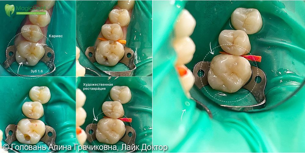 Лечение кариеса дентина 16-го зуба фото 2 · Сочи