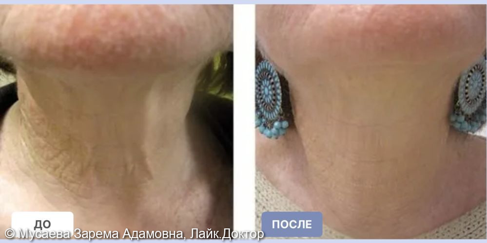 Игольчатый RF лифтинг на аппарате InMode Morpheus 8 фото 3 · Москва