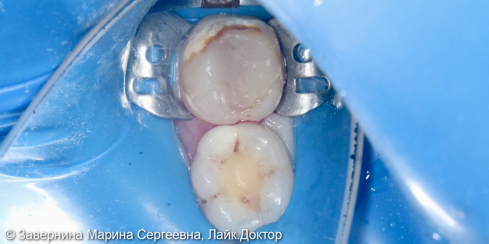 Лечение кариеса зубов 4.6, 4.7 - фото №1