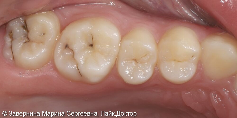 Лечение кариеса зубов 1.6, 1.7, 1.5, 1.4 - фото №1