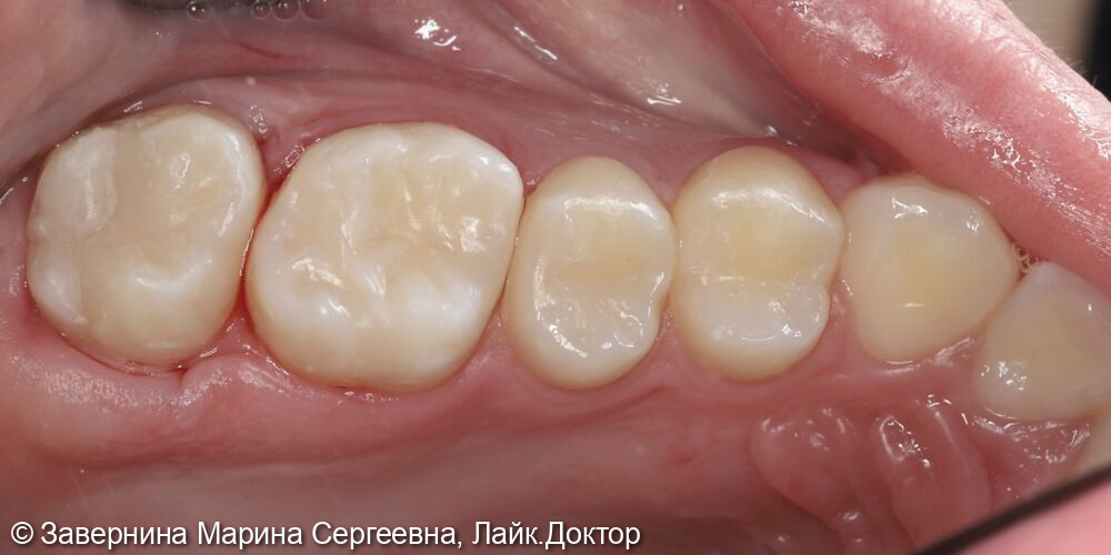 Лечение кариеса зубов 1.6, 1.7, 1.5, 1.4 - фото №7