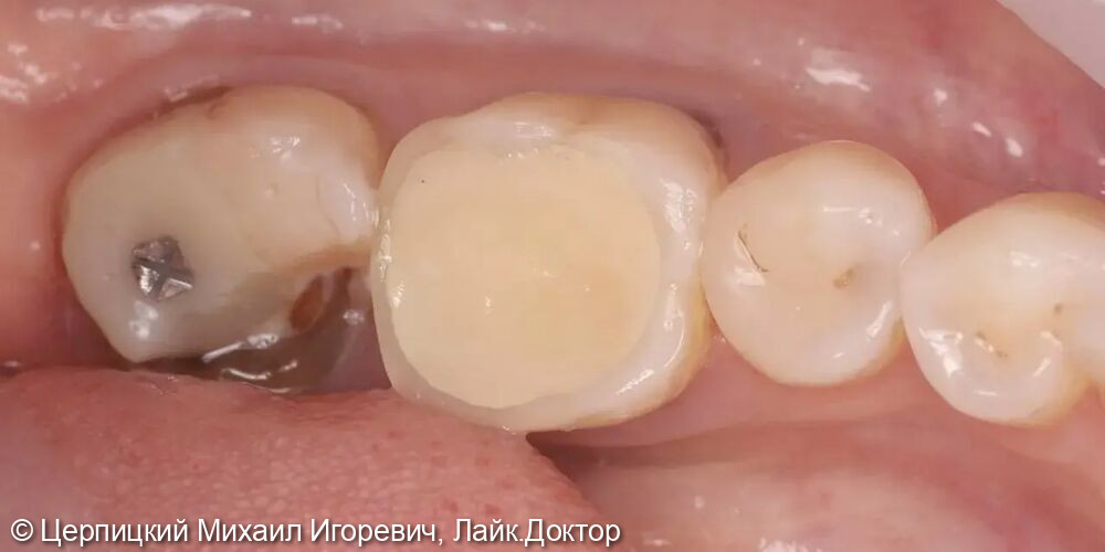 Одномоментная имплантация - фото №1