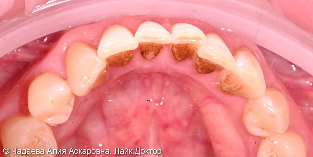 Комплексная гигиена с удалением темного пигментного налёта - фото №1