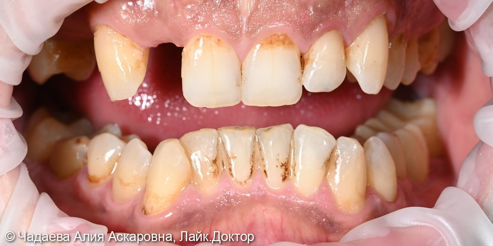 Комплексная гигиена полости рта по швейцарскому протоколу GBT - фото №1