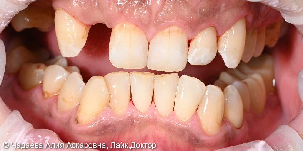 Комплексная гигиена полости рта по швейцарскому протоколу GBT - фото №2