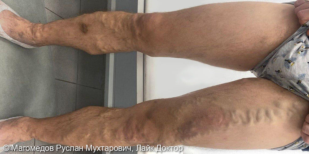 Лечение после тромбофлебита варикозно расширенных вен - фото №1