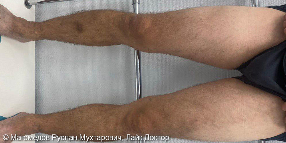 Лечение после тромбофлебита варикозно расширенных вен - фото №2