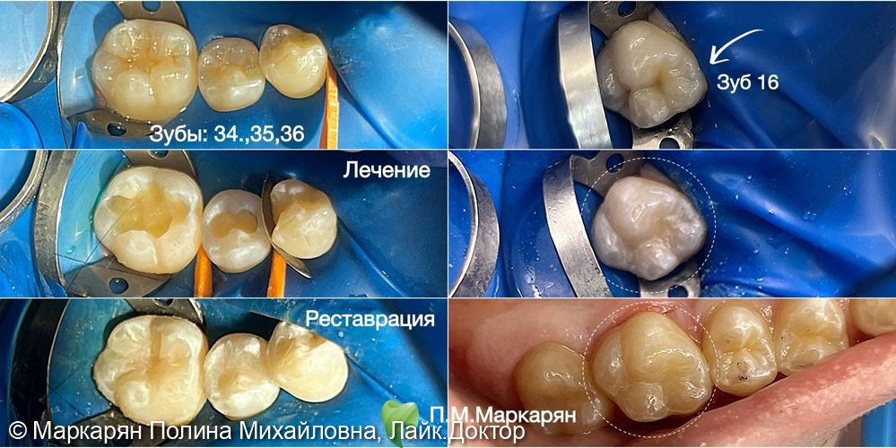 Лечение кариеса постоянных зубов у детей - фото №1