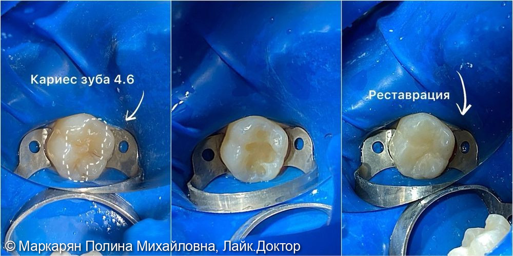 Лечение среднего кариеса постоянного зуба у мальчика 7-ми лет - фото №1