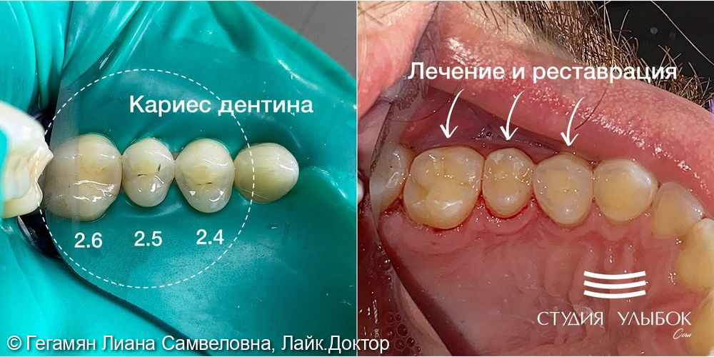 Лечение кариеса на жевательных и контактных поверхностях сразу 3-х зубов: 2.6, 2.5, 2.4 у молодого человека 30-ти лет - фото №3