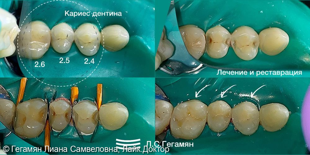 Лечение кариеса на жевательных и контактных поверхностях сразу 3-х зубов: 2.6, 2.5, 2.4 у молодого человека 30-ти лет - фото №1