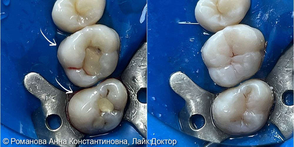 Лечение рецидива кариеса с заменой старых пломб - после