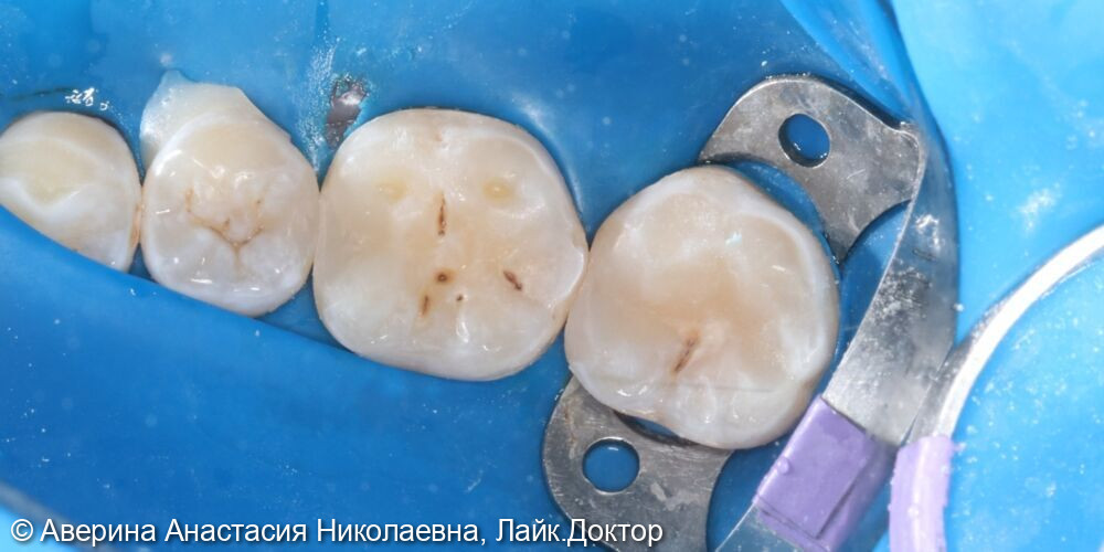 Лечение кариеса зубов 35, 36, 37 зубов - фото №7