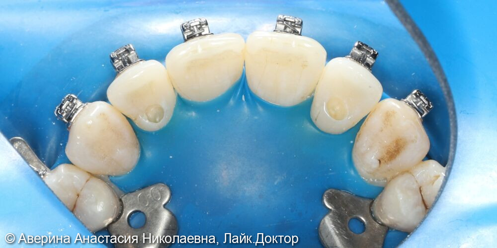 Лечение среднего картеса фронтальных зубов - после