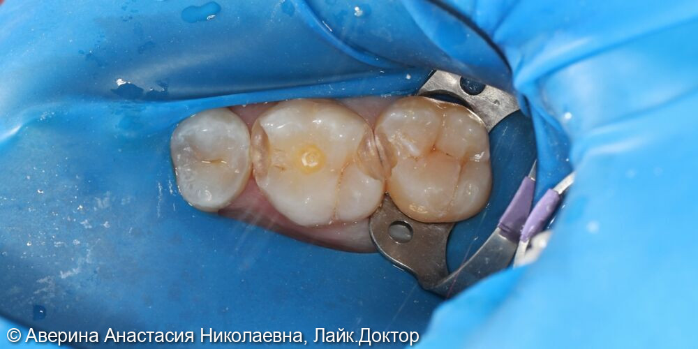 Лечение среднего кариеса 15, 16, 17 зубов - после