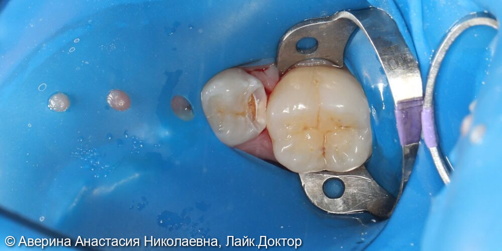 Лечение глубокого кариеса 35 зуба фото 2 · Вологда