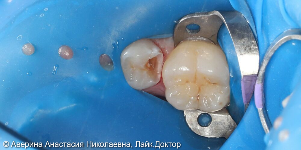 Лечение глубокого кариеса 35 зуба фото 3 · Вологда
