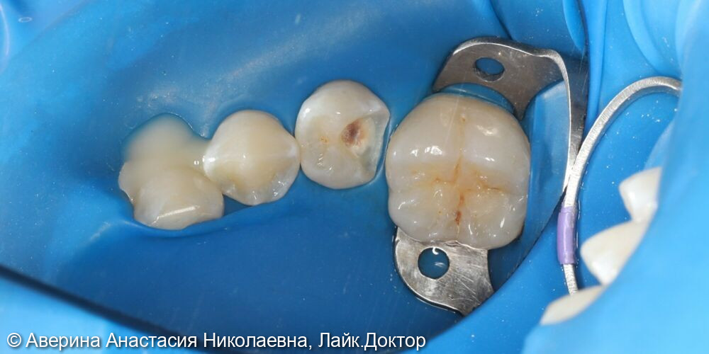 Лечение глубокого кариеса 35 зуба фото 4 · Вологда