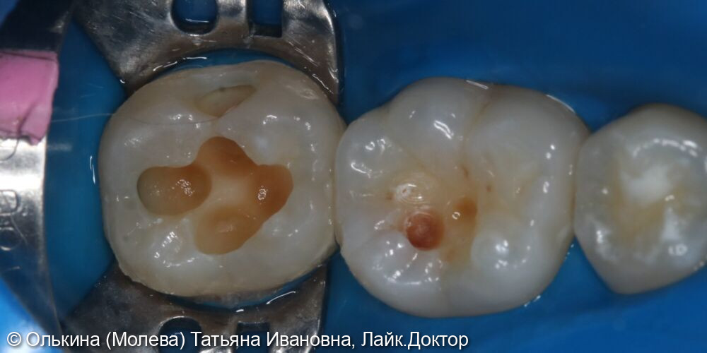 Лечение кариеса зубов 4.7, 4.6 фото 2 · Вологда