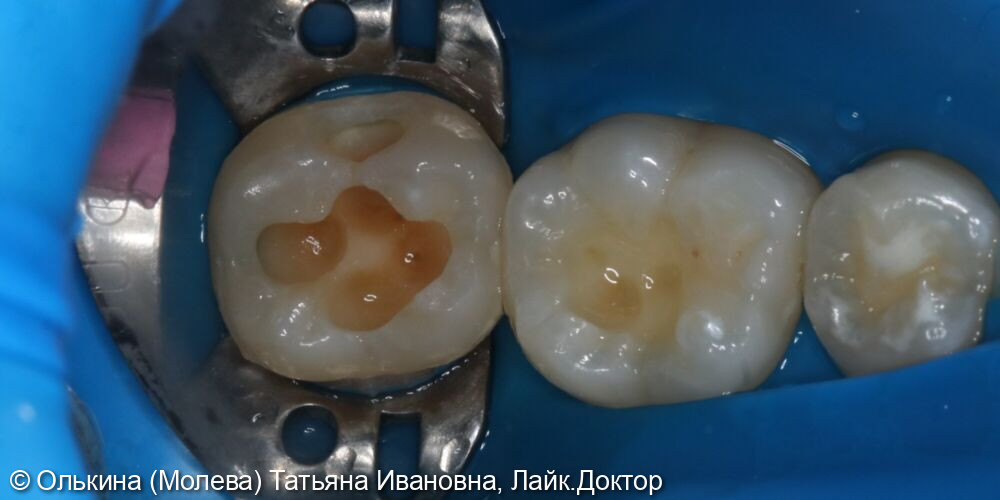 Лечение кариеса зубов 4.7, 4.6 фото 3 · Вологда