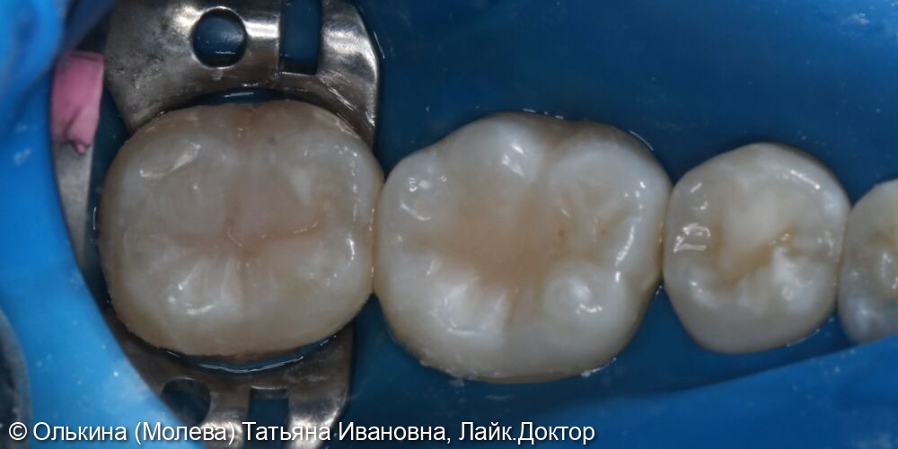 Лечение кариеса зубов 4.7, 4.6 - фото №4
