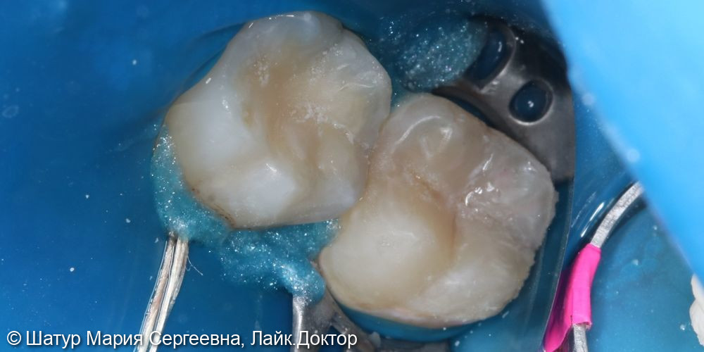Лечение кариеса постоянных зубов фото 4 · Вологда