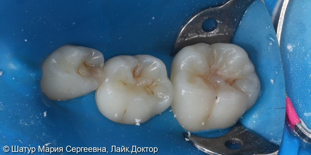 Лечение кариеса постоянного и временных зубов в один визит - фото №1