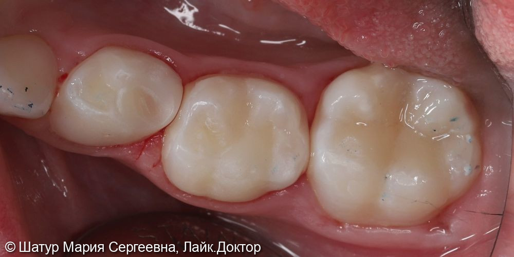 Лечение кариеса постоянного и временных зубов в один визит - фото №5