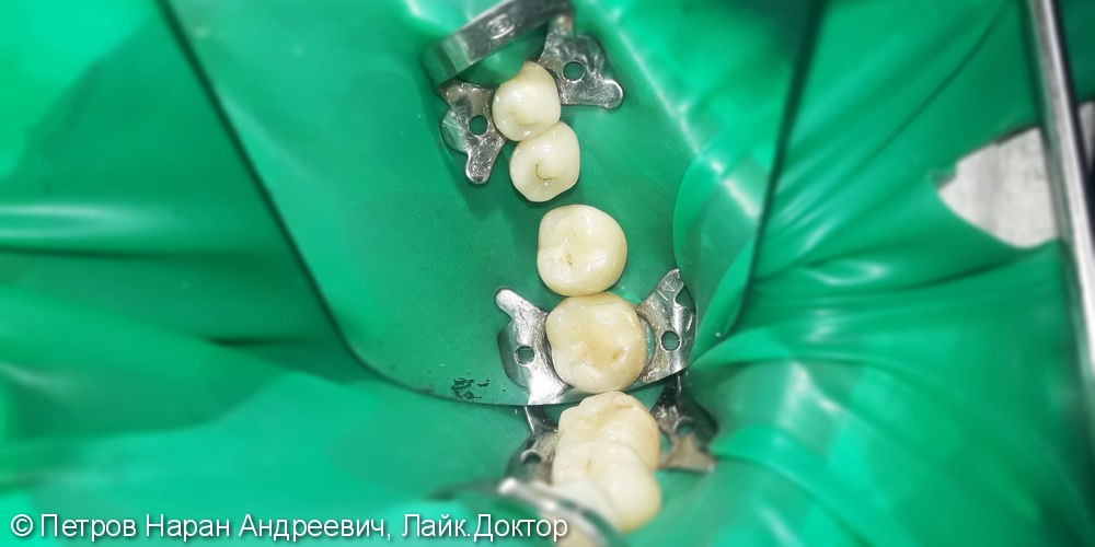 Лечение и реставрация трех зубов фотополимером Esthet-X - фото №1