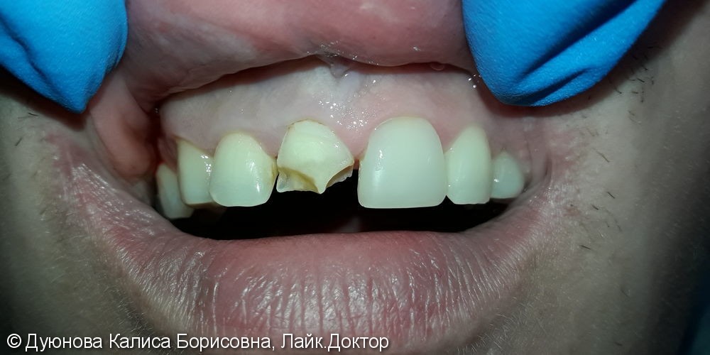 Художественная реставрация фронтальной поверхности зуба композитным материалом Estet X - фото №1