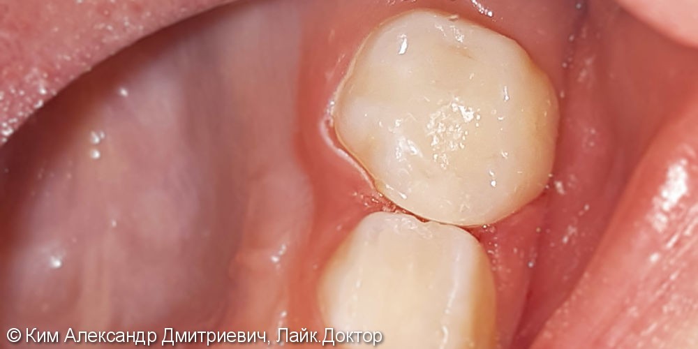 Лечение и реставрация зуба №65 фотополимером Filtek - фото №4