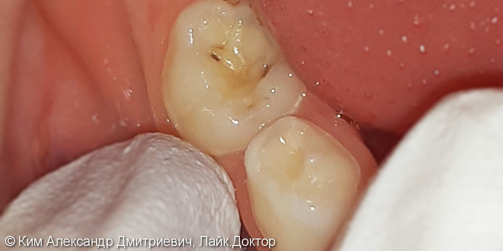Лечение и реставрация зуба №85 фотополимером Esthet-X - фото №1