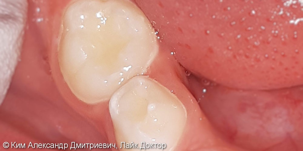 Лечение и реставрация зуба №85 фотополимером Esthet-X - фото №3