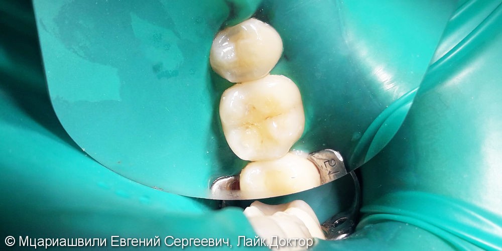 Лечение и реставрация зуба №16 фотополимером российского производства - фото №1
