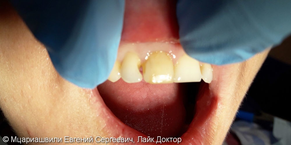 Эстетическая реставрация зуба №12 фотополимером Esthet-X - фото №1