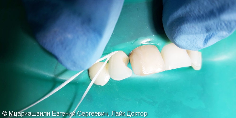 Эстетическая реставрация зуба №12 фотополимером Esthet-X - фото №2