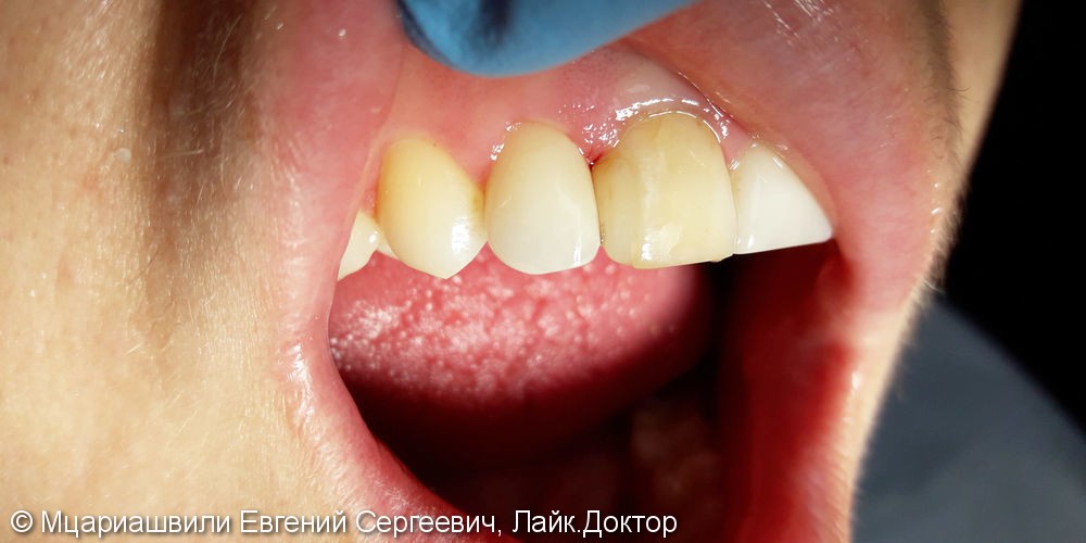 Эстетическая реставрация зуба №12 фотополимером Esthet-X - фото №5