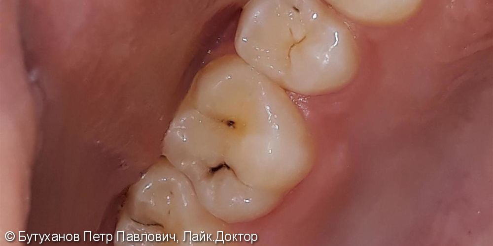 Проблема – кариес на четырех зубах - фото №1