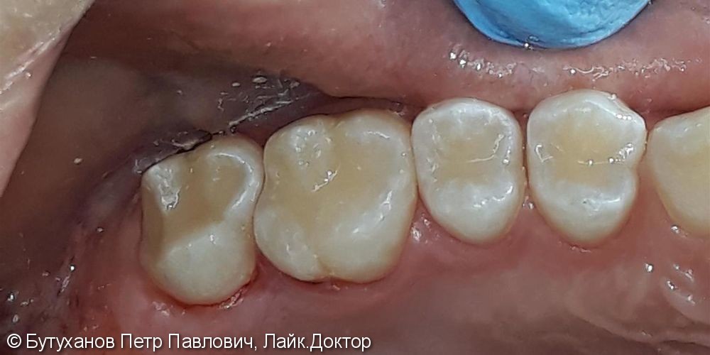 Проблема – кариес на четырех зубах - фото №3