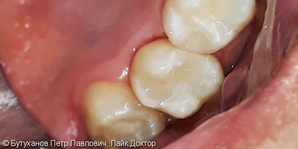 Реставрация трех зубов нижней челюсти с использованием фотополимера Filtek - фото №3