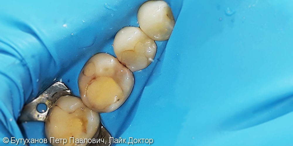 Лечение трех зубов нижней челюсти с использованием светоотверждаемого материала отечественного производства - фото №1