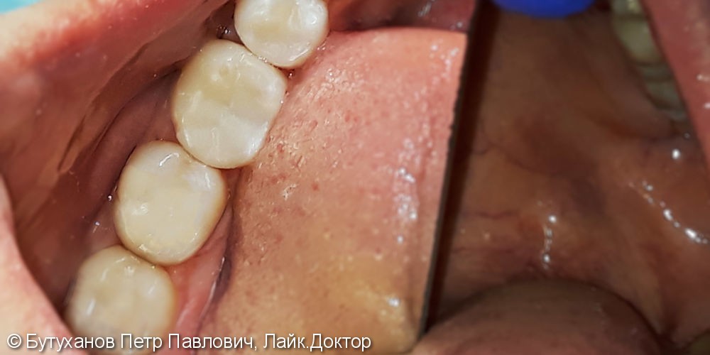 Лечение трех зубов нижней челюсти с использованием светоотверждаемого материала отечественного производства - фото №3