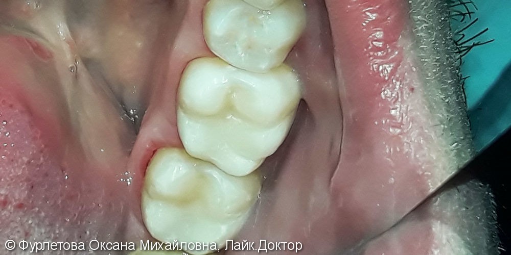Лечение и реставрация зубов №36/№37 фотополимером Filtek - фото №3